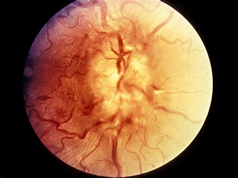 Moran Core Optic Nerve