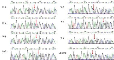 Sanger Sequence Analysis For Validation Of Exome Sequencing Variant