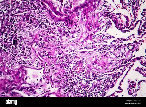 Histopathology Of Smoker S Lung Light Micrograph Showing Accumulation