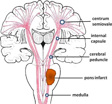 Pontine Infarction Diffusion Tensor Imaging Of Motor Pathways—a