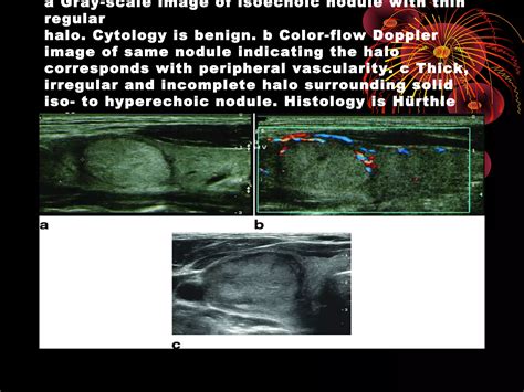 Thyroid ultrasound | PPT