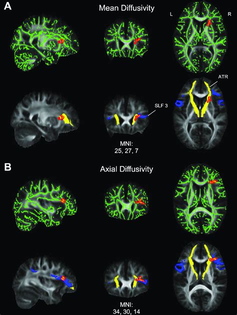 Relationship Between Diffusion Tensor Imaging DTI Metrics And