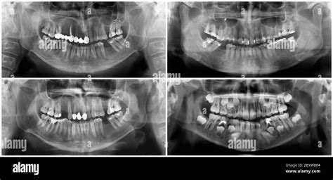 Radiografia Panoramica Dentale Immagini Senza Sfondo E Foto Stock