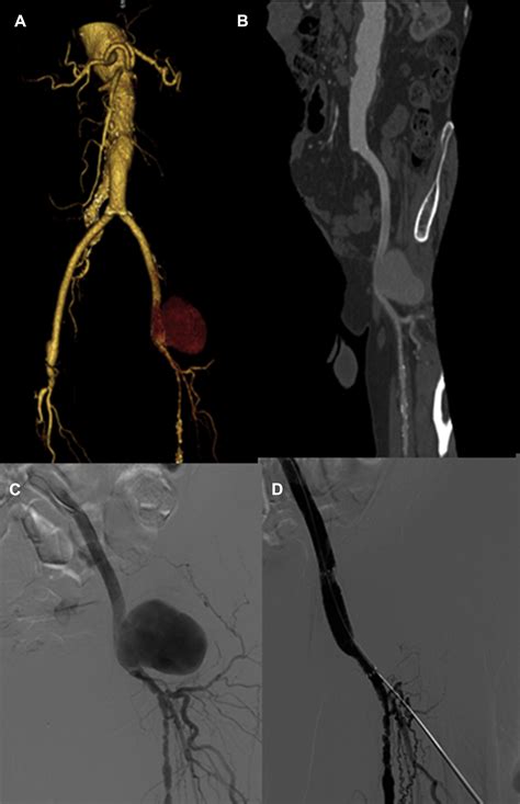 Endovascular Treatment Of Aorto Iliac Femoral Anastomotic