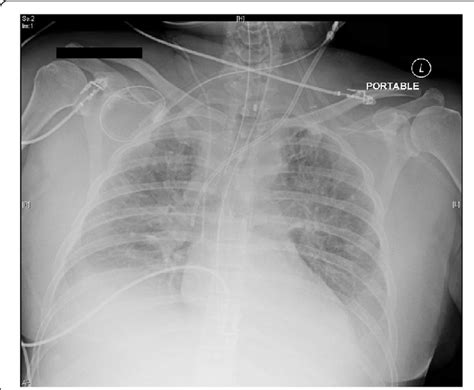 Portable Anterior Posterior Chest X Ray Revealing Diffuse Bilateral