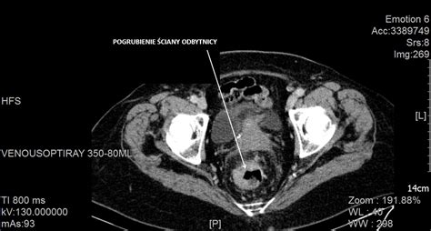 Nowotw R Odbytnicy Rak Odbytnicy Dla Lekarzy
