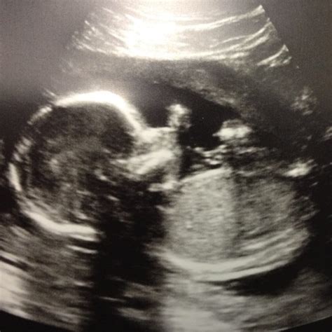 Group B Strep In Pregnancy Probiotic Benefits Altavie Health Kelowna