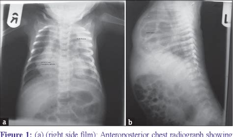 Figure 1 From Spontaneous Resolution Of A Congenital Multicystic Lung