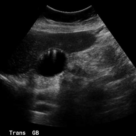 Gallbladder adenomyomatosis | Radiology Case | Radiopaedia.org ...