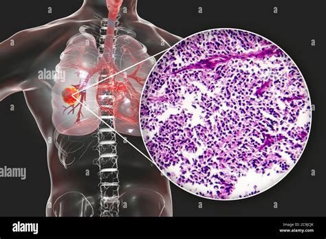 Carcinoma Epidermoide Immagini E Fotografie Stock Ad Alta Risoluzione