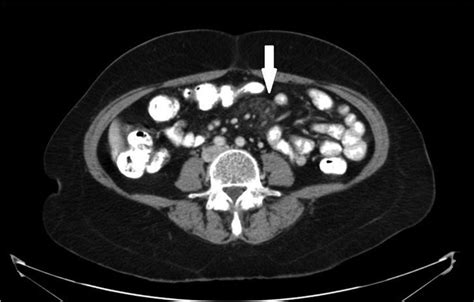 Limited Systemic Sclerosis Initially Presenting With Mesenteric Panniculitis Bmj Case Reports