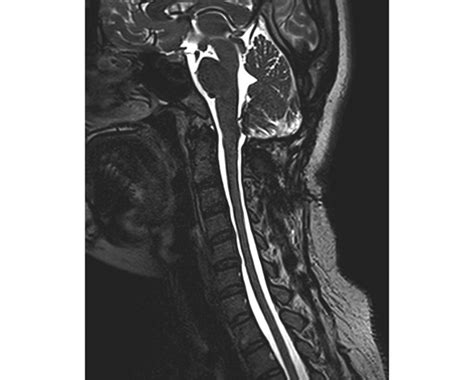 Postoperative MRI scan obtained at 8 months, showing completely ...