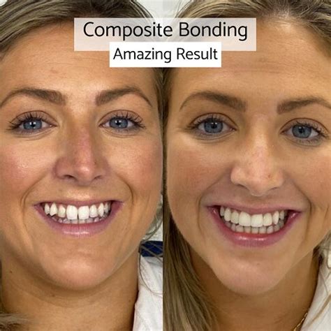 How Long Does Composite Bonding Take Whites Dental