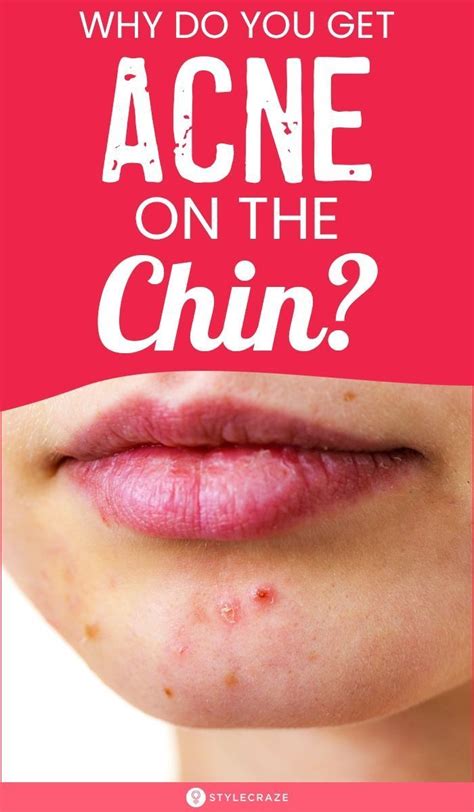 Chin Acne Pimples Causes Treatment And Skin Care Tips Artofit