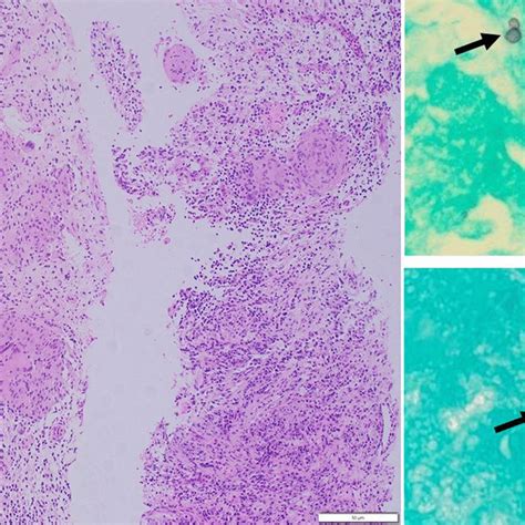 A B And C Hande Stain And Low Power View Shows Granulomatous Lesions