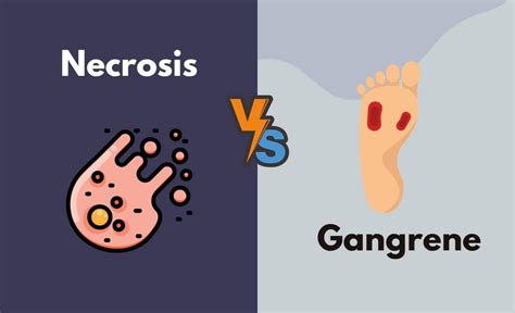 Gangrene Causes Signs And Symptoms Diagnosis And 51 Off