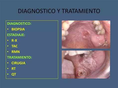 Tumores Benignos Y Malignos De Cavidad Oral PPT