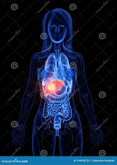 A Womans Liver Tumor Stock Illustration Illustration Of Hemochromatosis 144928723