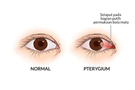 Mata Ada Selaput Putih