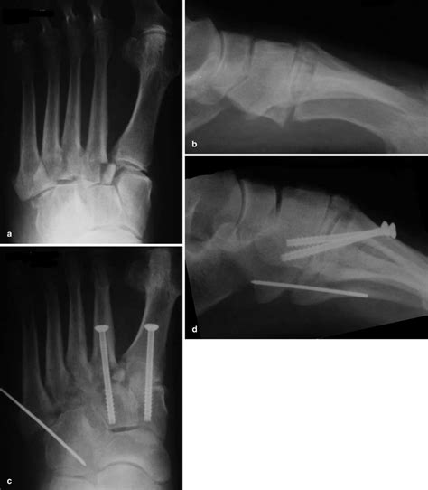 Ab Type A Fracture Dislocation Of The Lisfranc Joint Dorsoplantar And Download Scientific