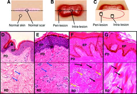 Cutaneous Scarring Basic Science Current Treatments And Future