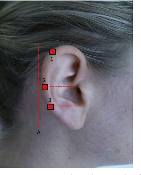 Figure 2 From A Strategy For Assessing Otoplasty Outcome Intra