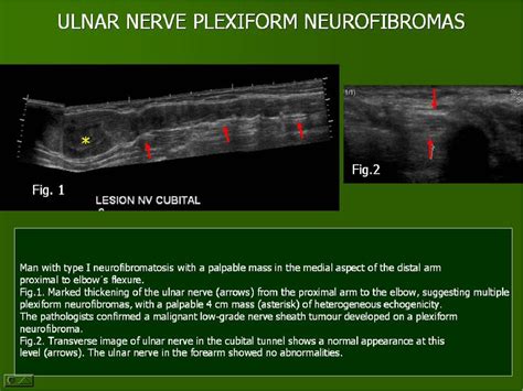 Ultrasound Of The Elbow What The Radiologist Should Know Semantic