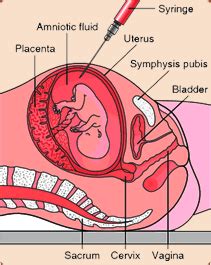 Amniocentesis Test - POGU