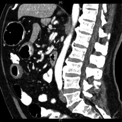 There Is Focal Dissection Of The Superior Mesenteric Artery Sma