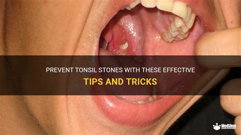 Prevent Tonsil Stones With These Effective Tips And Tricks Medshun