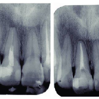 Color Online Periapical X Ray Images Red Arrows Indicate Regions Of