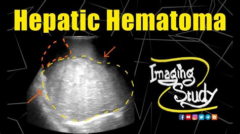 Hepatic Hematoma Ultrasound Case 177 Youtube