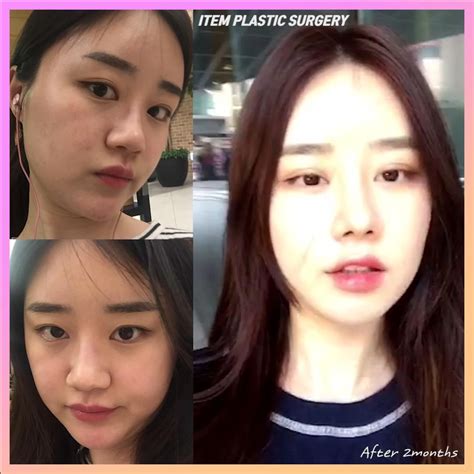 31 Crazy Before And After Photos Of Korean Plastic Surgery Artofit