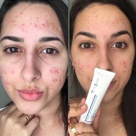 Antes E Depois Da ACNE Blog Primeiro Encontro Tratamento Para