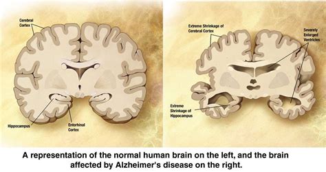 Alzheimer's Disease - A Brief History and Description