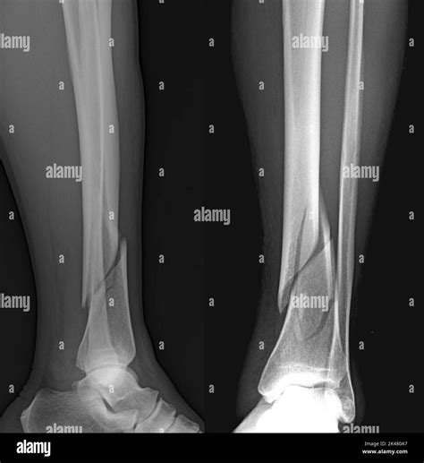 Fracture Du Tibia Banque De Photographies Et Dimages Haute