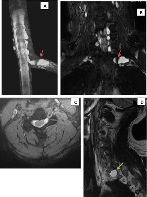 Male Patient Aged 22 Years With LT C6 Spinal Nerve Root Injury And