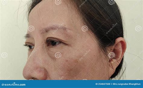 The Flabby Wrinkles And Ptosis Beside The Eyelid Stock Photo Image Of