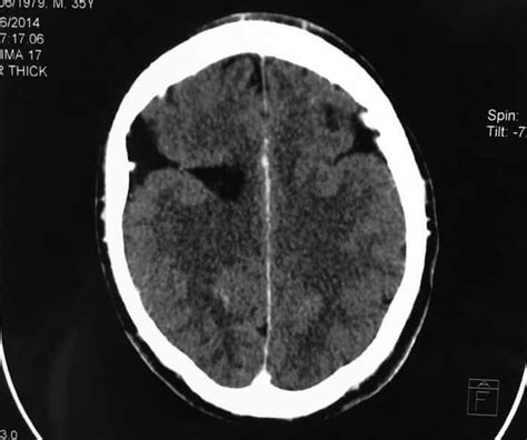 Bilateral Open Lip Schizencephaly Cns Head And Neck Brain Open