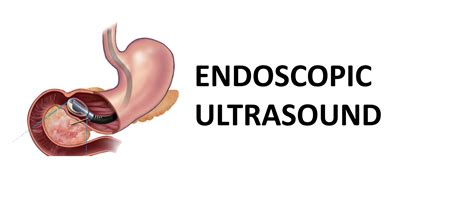 Endoscopic Ultrasound Upper Gi Endoscopy Ahmedabad Dr Bhavesh