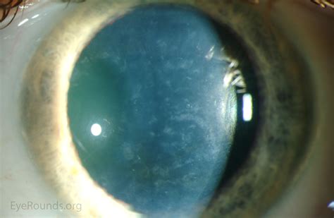 Atlas Entry Posterior Polymorphous Corneal Dystrophy Ppmd