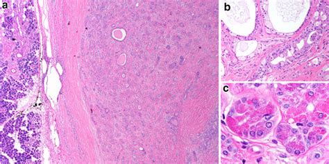 Sclerosing Polycystic Adenosis A This Lesion Consists Of A Tubular To