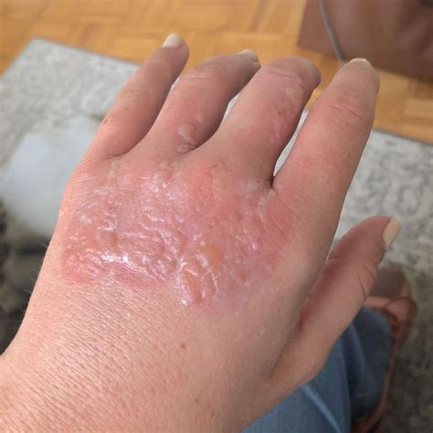 This Womans Blistering Burn Shows Why You Should Never Make A Margarita In The Sun