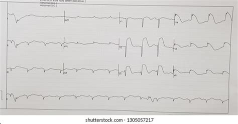 Extensive Anterior Wall Stemi Foto Stock Shutterstock | Hot Sex Picture