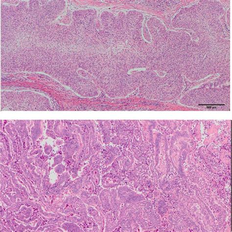 Microscopic Observation Of The Cystectomy Specimen Urothelial