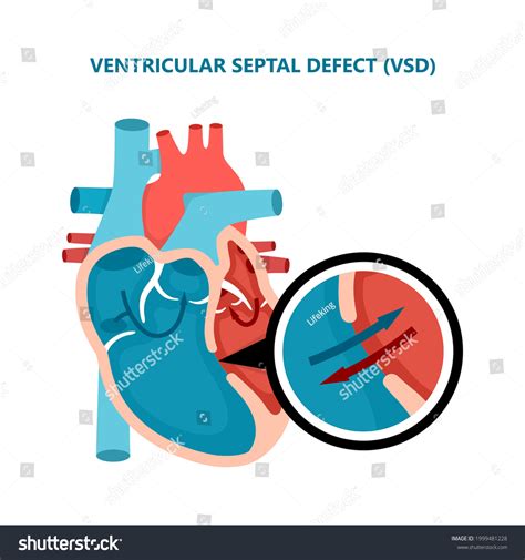 Ventricular Septal Defect Vsd Human Heart Stock Vector Royalty Free