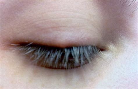 Red Bump On Lash Line Ingrown Eyelash Pictures Treatments And Prevention