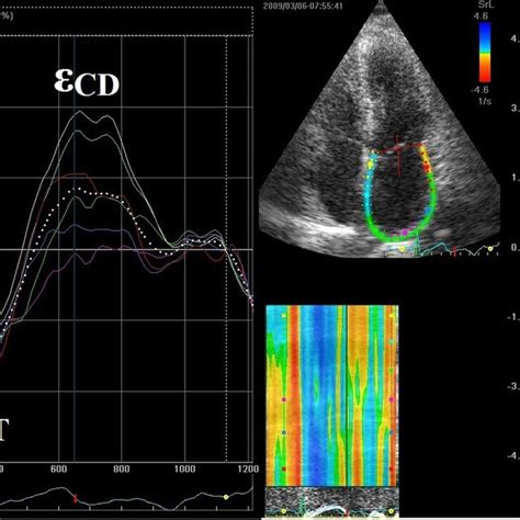 Left Atrial Strain And Strain Rate Measured By Speckle Tracking Imaging