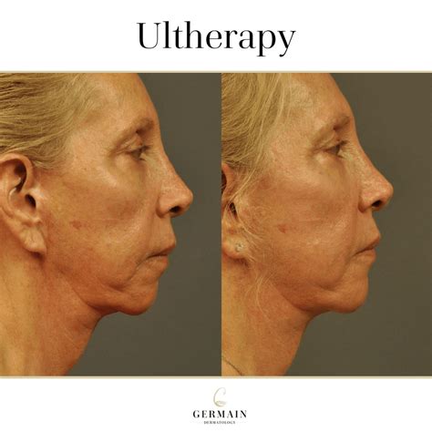 Ultherapy Mt Pleasant Pawleys Island Summerville In SC