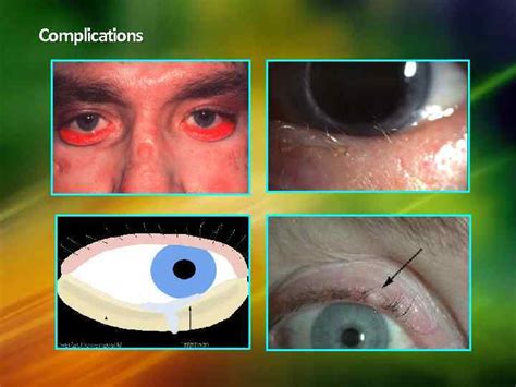 Disorders Of The Lacrimal System The Lacrimal